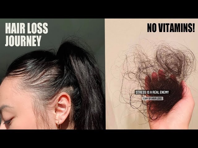 Can I regain hair loss from stress