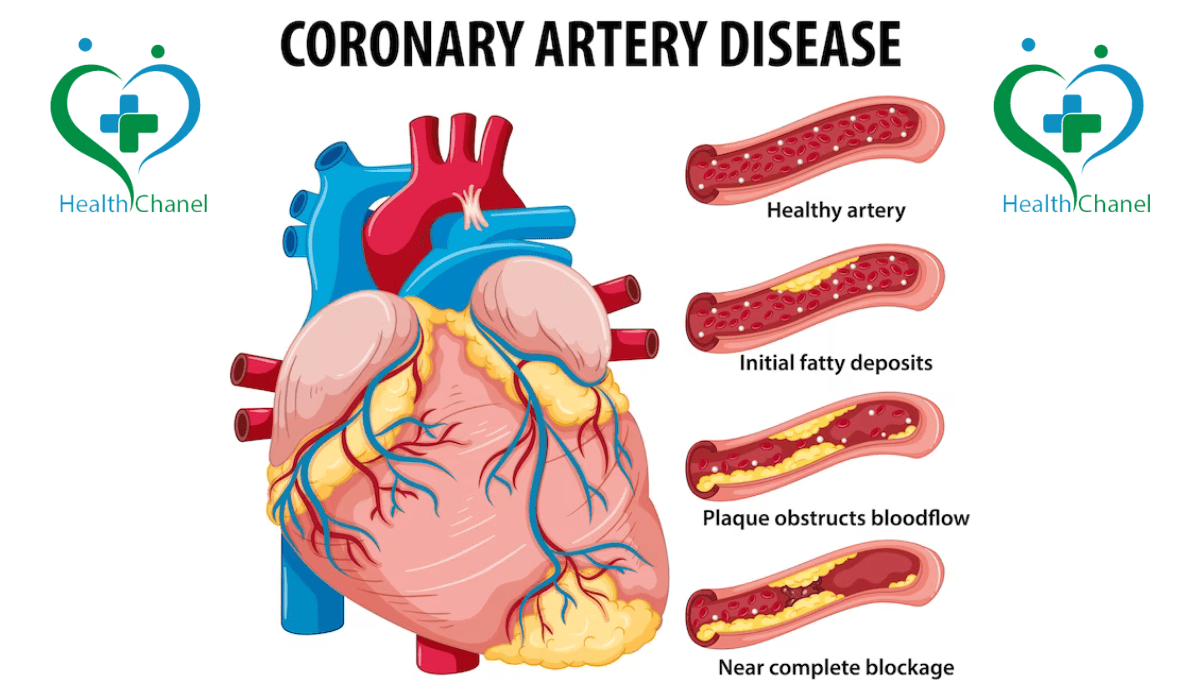 Coronary Artery Disease: Causes, Symptoms, and Treatment