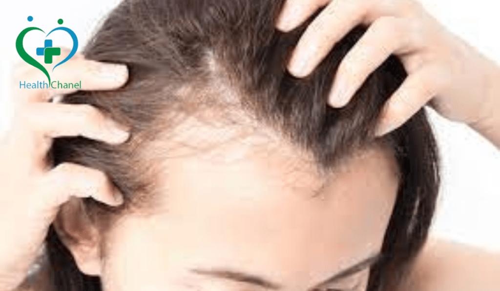 Creatine hair loss
