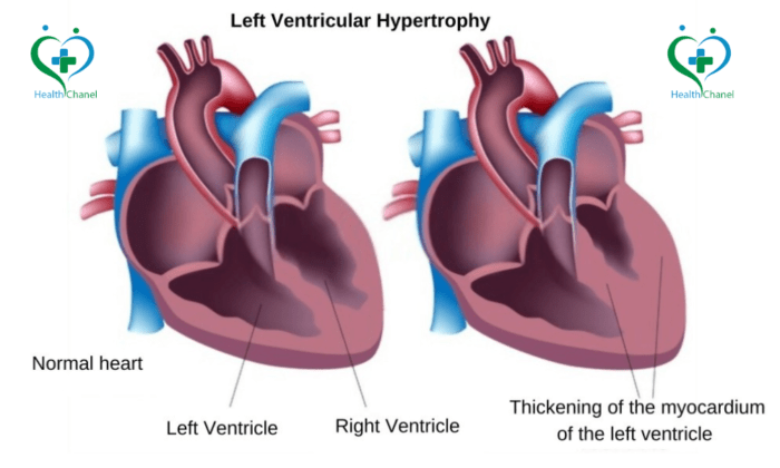 Left Ventricular Hypertrophy