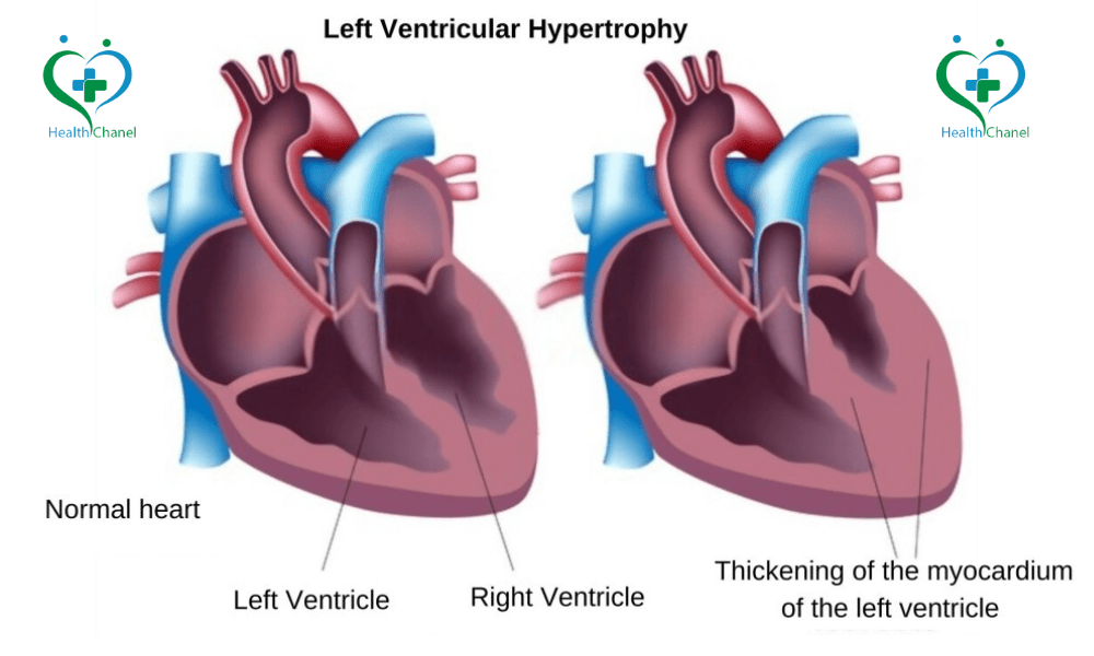 Left Ventricular Hypertrophy: Symptoms, Diagnosis and Treatment