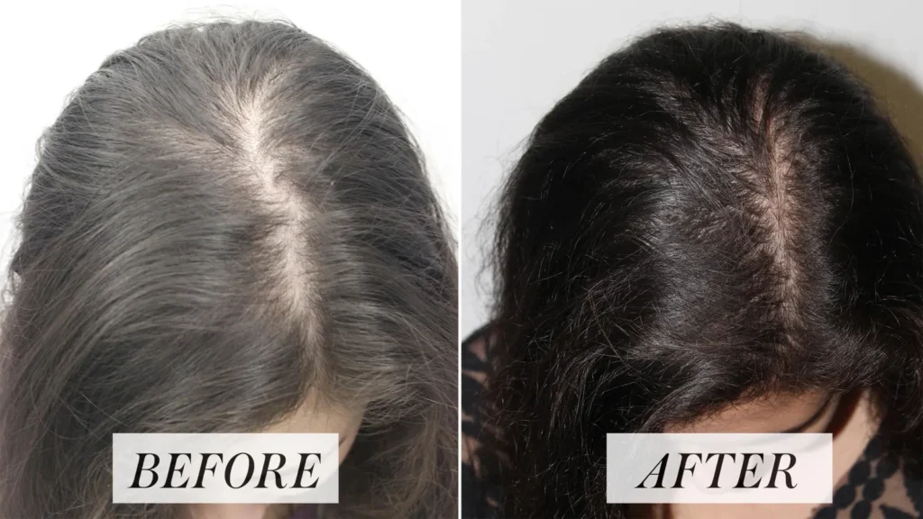 PRP hair Treatment for Women Before and after