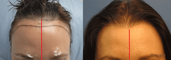 Female Fue hair transplant before and after