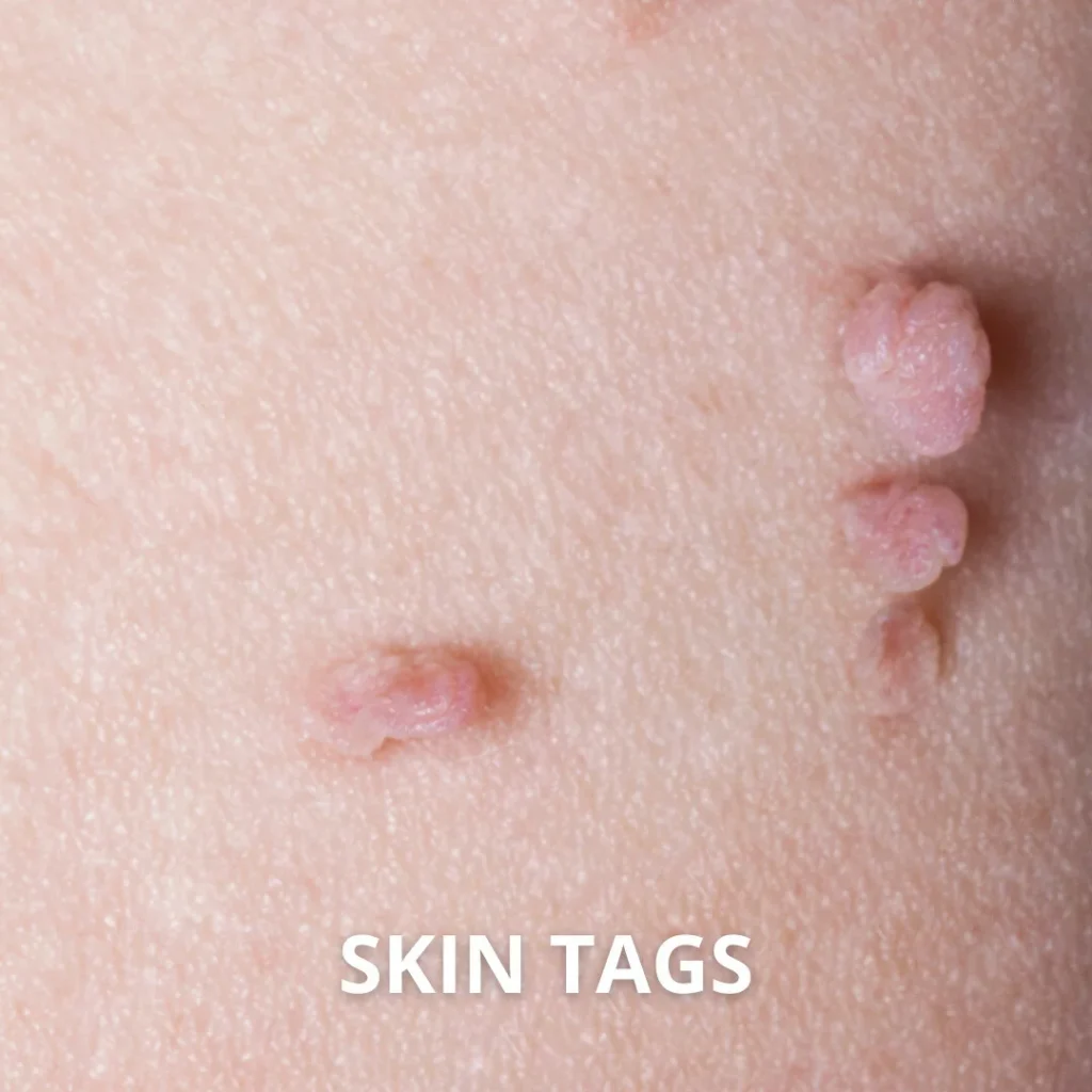 PCOS related skin tags