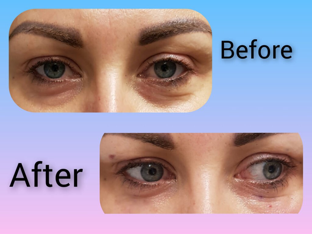 Before and after natural remedies effect on dark circle and puffy eyes