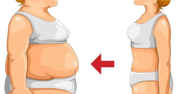 Weight gain related to PCOS