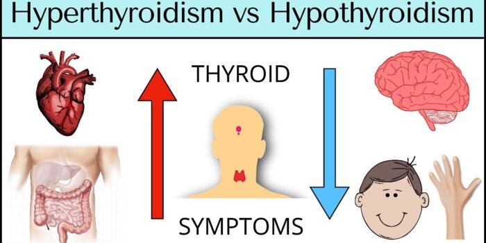 Hypothyroidism Vs. Hyperthyroidism In Women