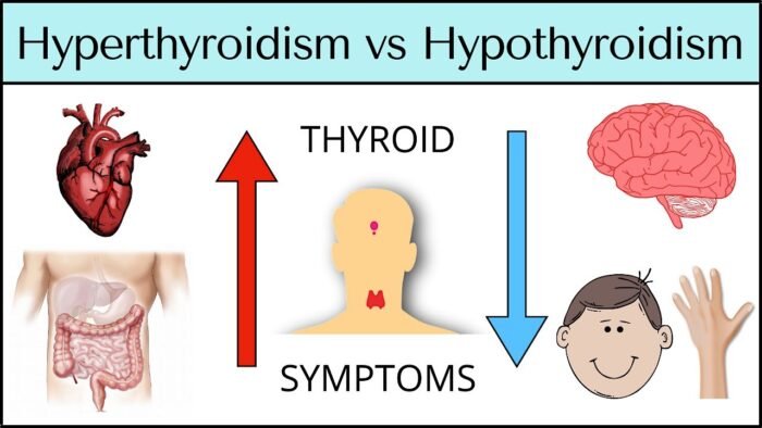 Hypothyroidism Vs. Hyperthyroidism In Women