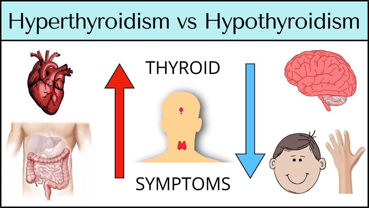 Hypothyroidism vs. Hyperthyroidism in Women: Key Differences, Symptoms & Treatments