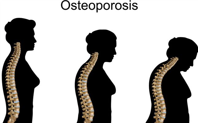 Osteoporosis in women