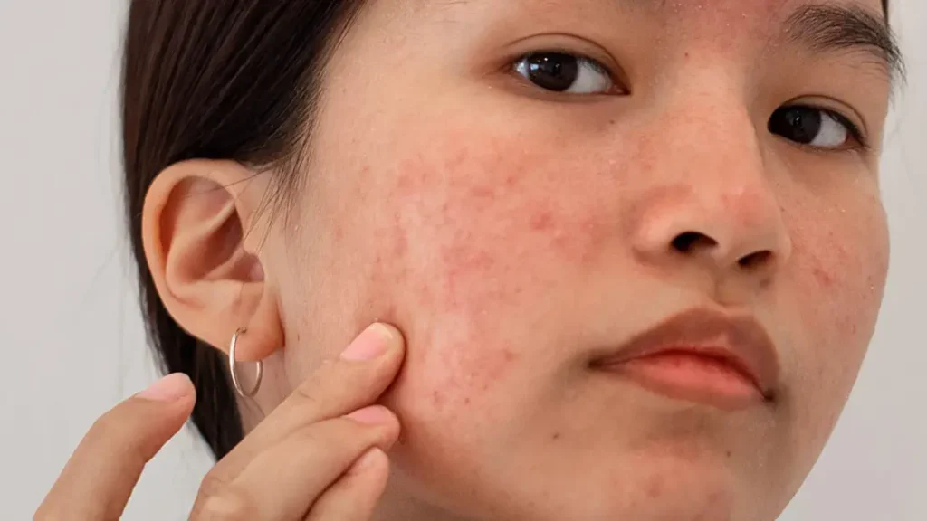 PCOS related acne