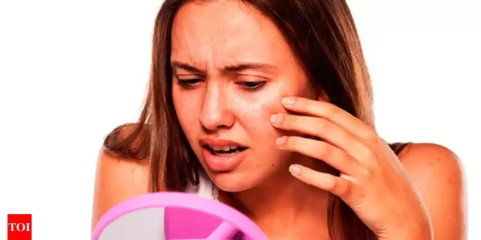 PCOS and skin