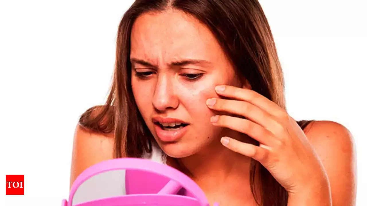 PCOS and skin