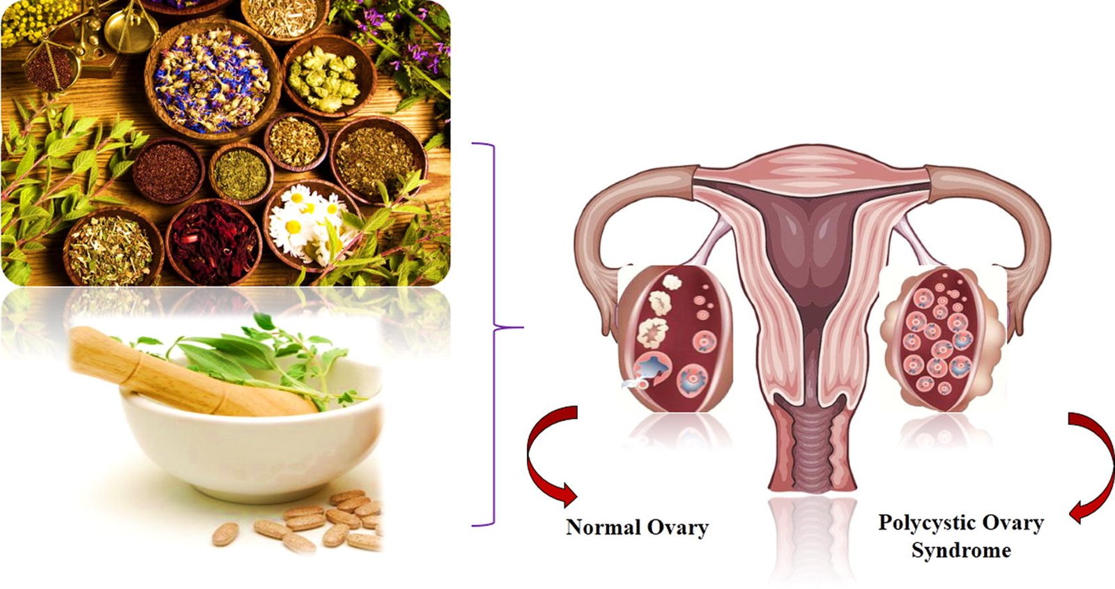 Herbal Remedies for PCOS: What the Science Says