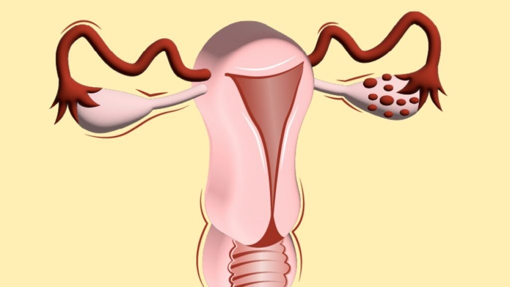 Impact of PCOS on mental health