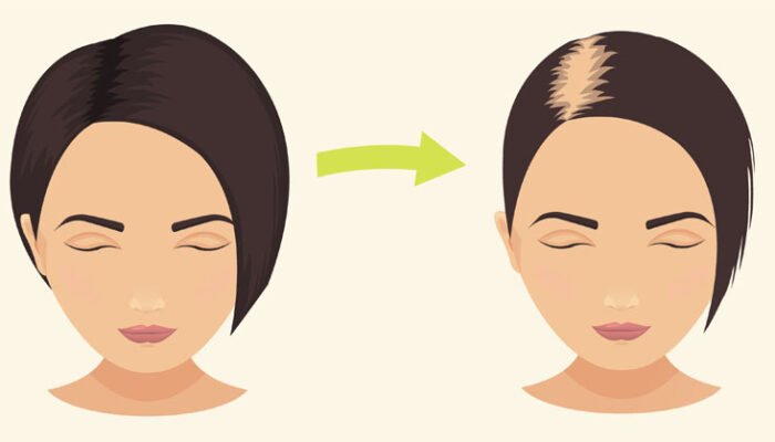 Can Thyroid Disorders Cause Hair Loss?