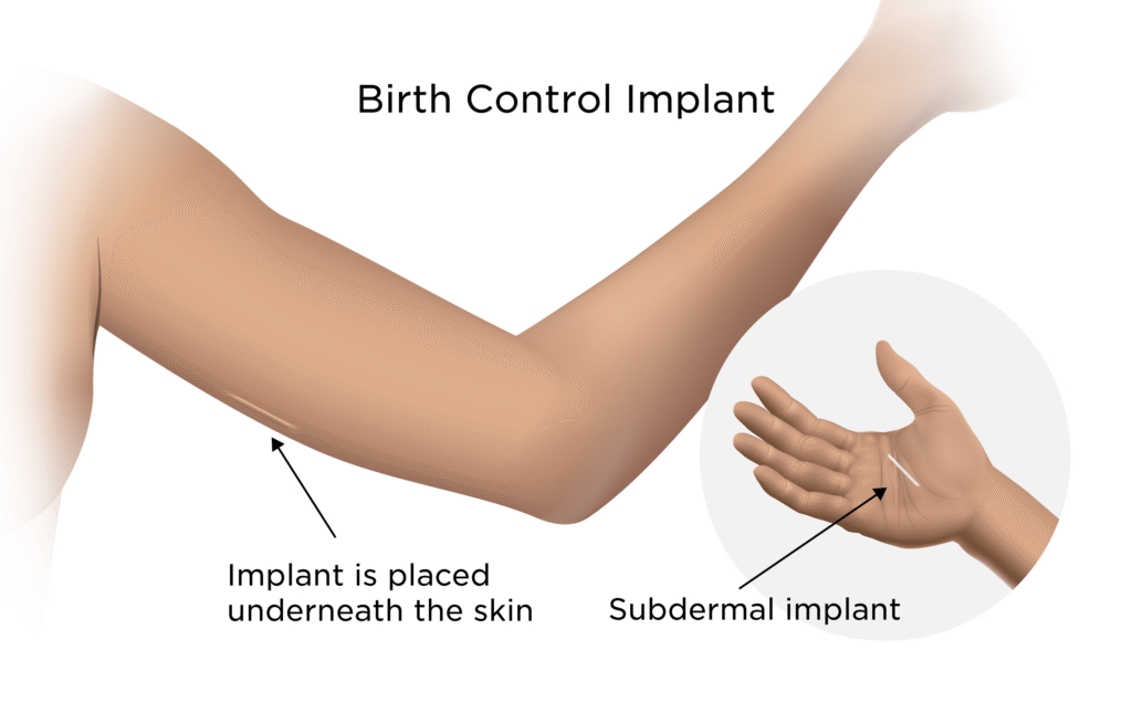 Birth control implant arm