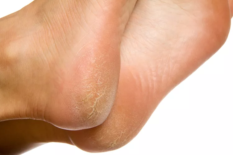 Why Are My Feet Peeling and How to Fix It