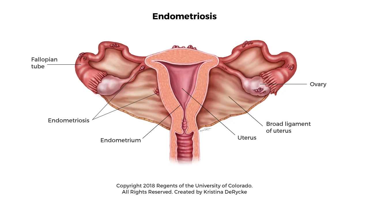 What Is Endometriosis? Symptoms, Causes, and Treatment