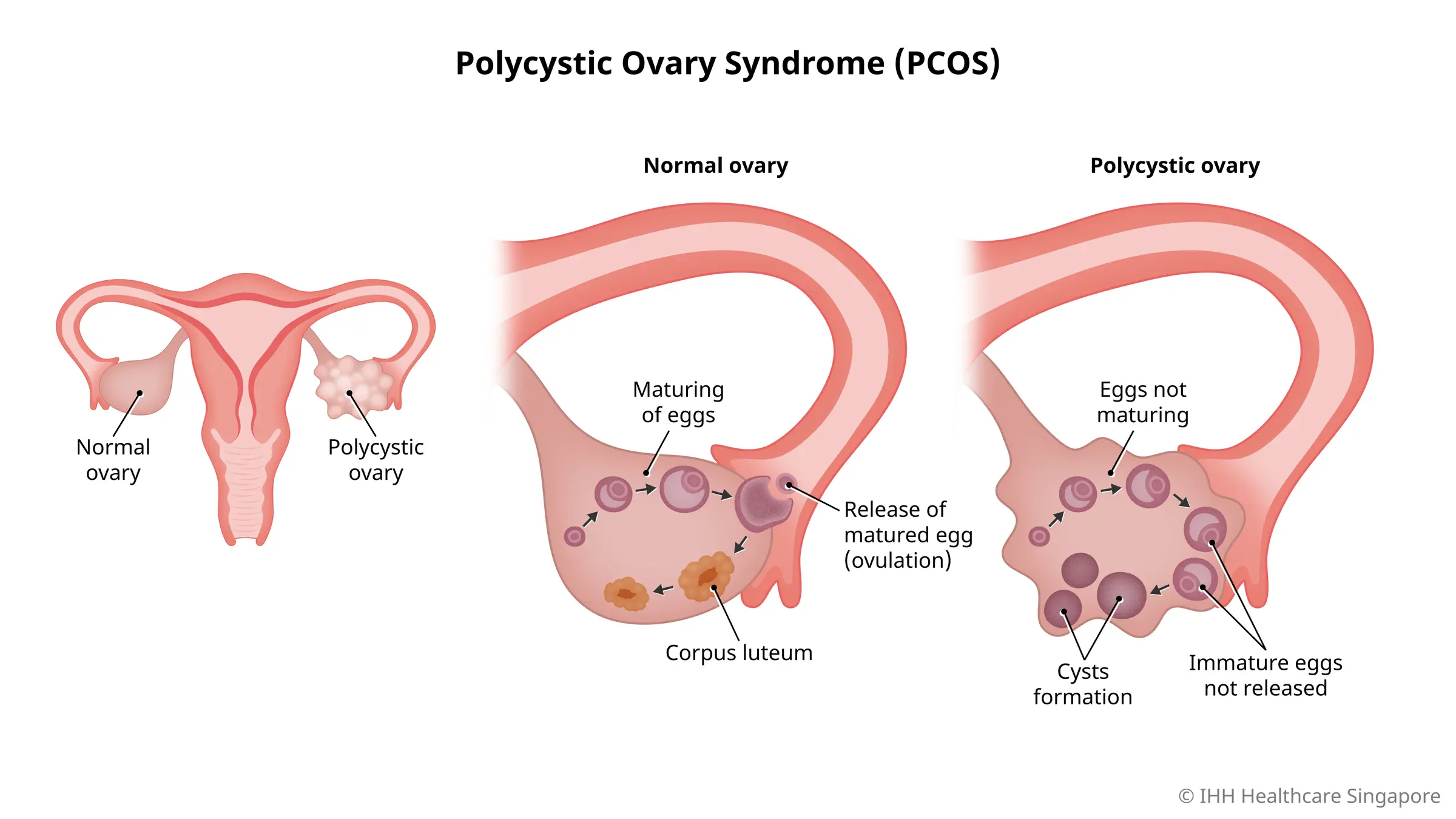 What Is Polycystic Ovarian Syndrome? Symptoms, Causes, and Treatment